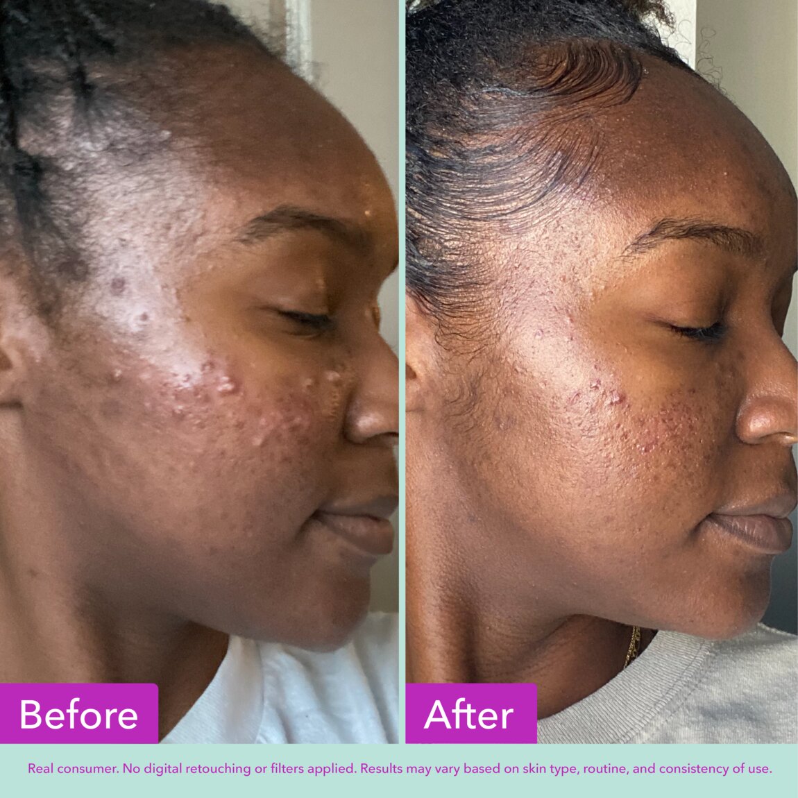 acne-foaming-cleanser-b5 zb_p.jpg