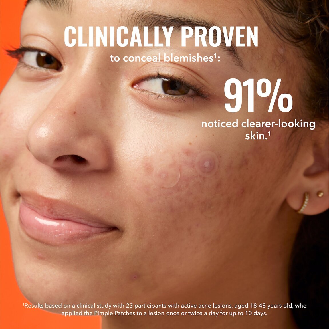 pimple-patches-z6 zb_p.jpg